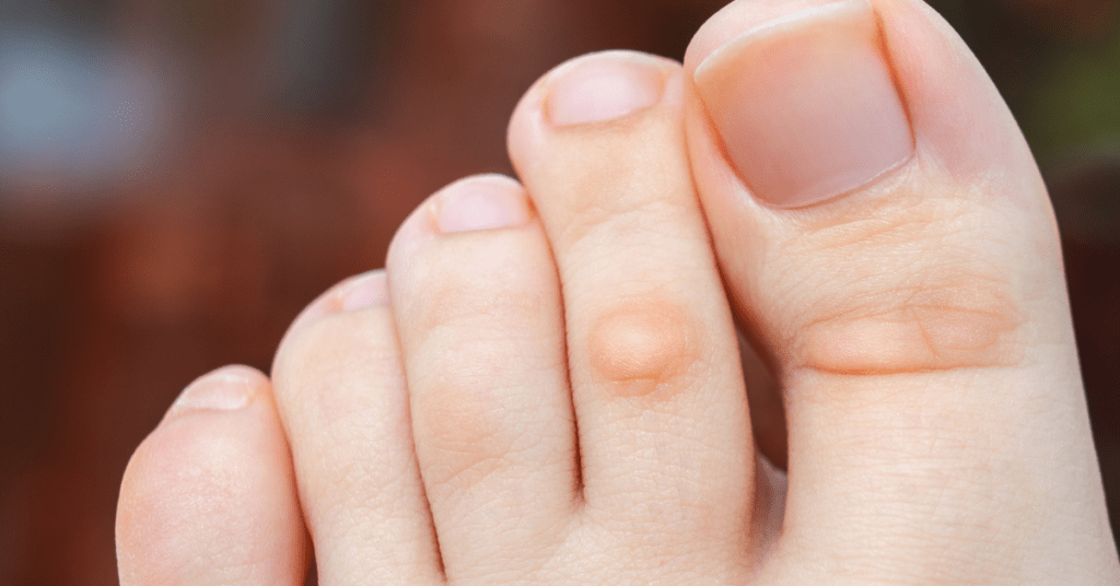 The Benefits of Custom Orthotics for Diabetics
