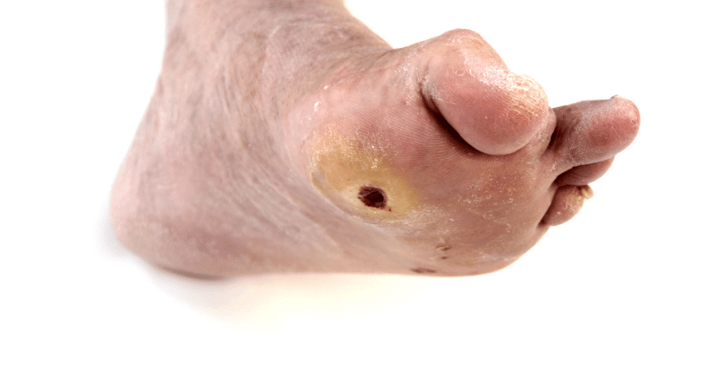 The Benefits of Custom Orthotics for Diabetics