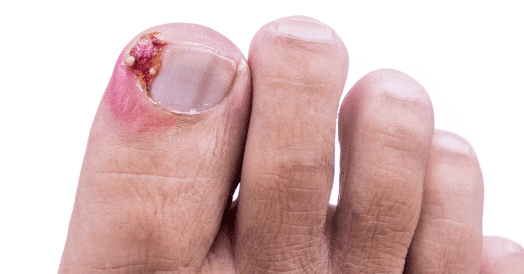 The Benefits of Custom Orthotics for Diabetics